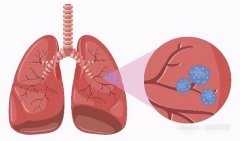 有肺结节的人，如何做有助养肺散结？