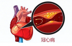 冠心病防治知识全解析，早知道早预防