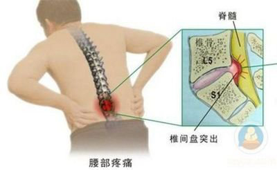 腰椎间盘突出症医案