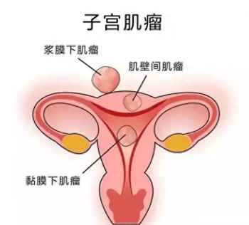 子宫肌瘤、子宫内膜增厚、及腺肌症治疗案例